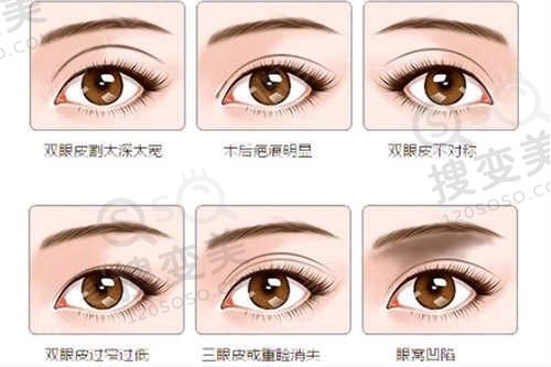 上海双眼皮手术哪家医院比较好？这五家医院实力上榜！