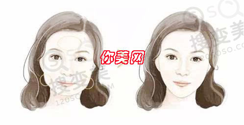 瘦脸不一定必须采用磨骨的方案，你可能只需要面部抽脂或者打瘦脸针