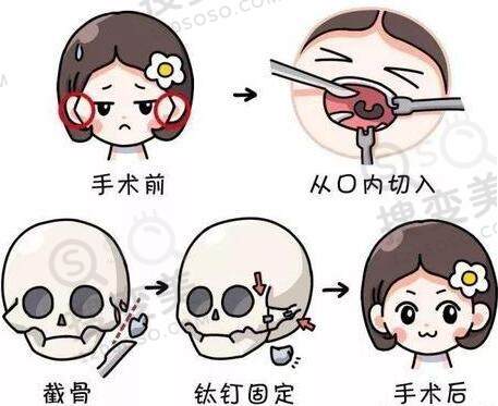 下颌角手术后会造成皮肤松弛吗？