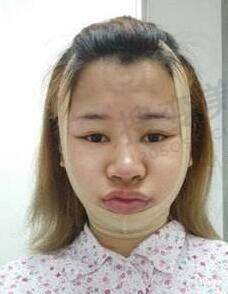 下颌角手术后会造成皮肤松弛吗？