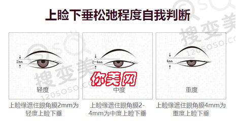上睑下垂矫正手术后为什么眼睛闭不上