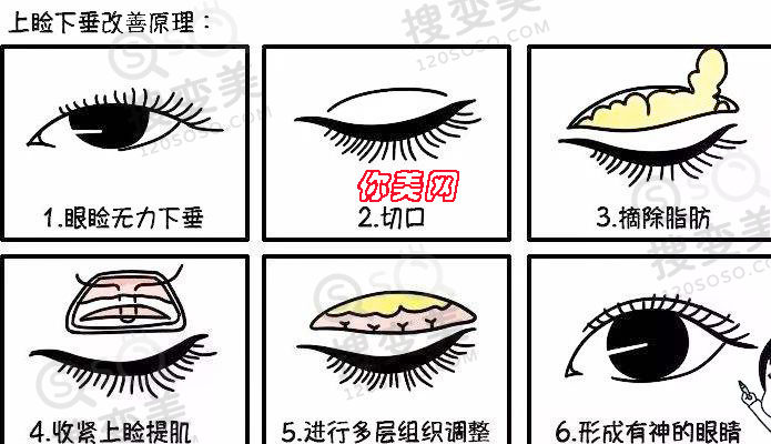 上睑下垂矫正手术后为什么眼睛闭不上