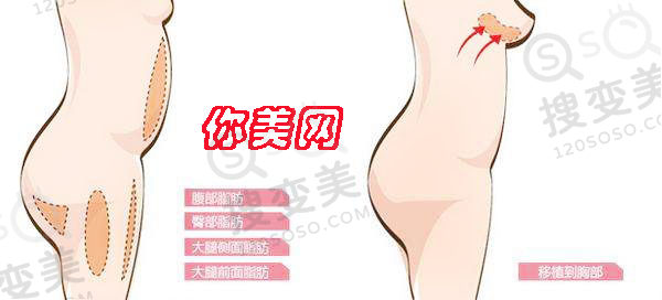 自体脂肪隆胸术后会致癌吗