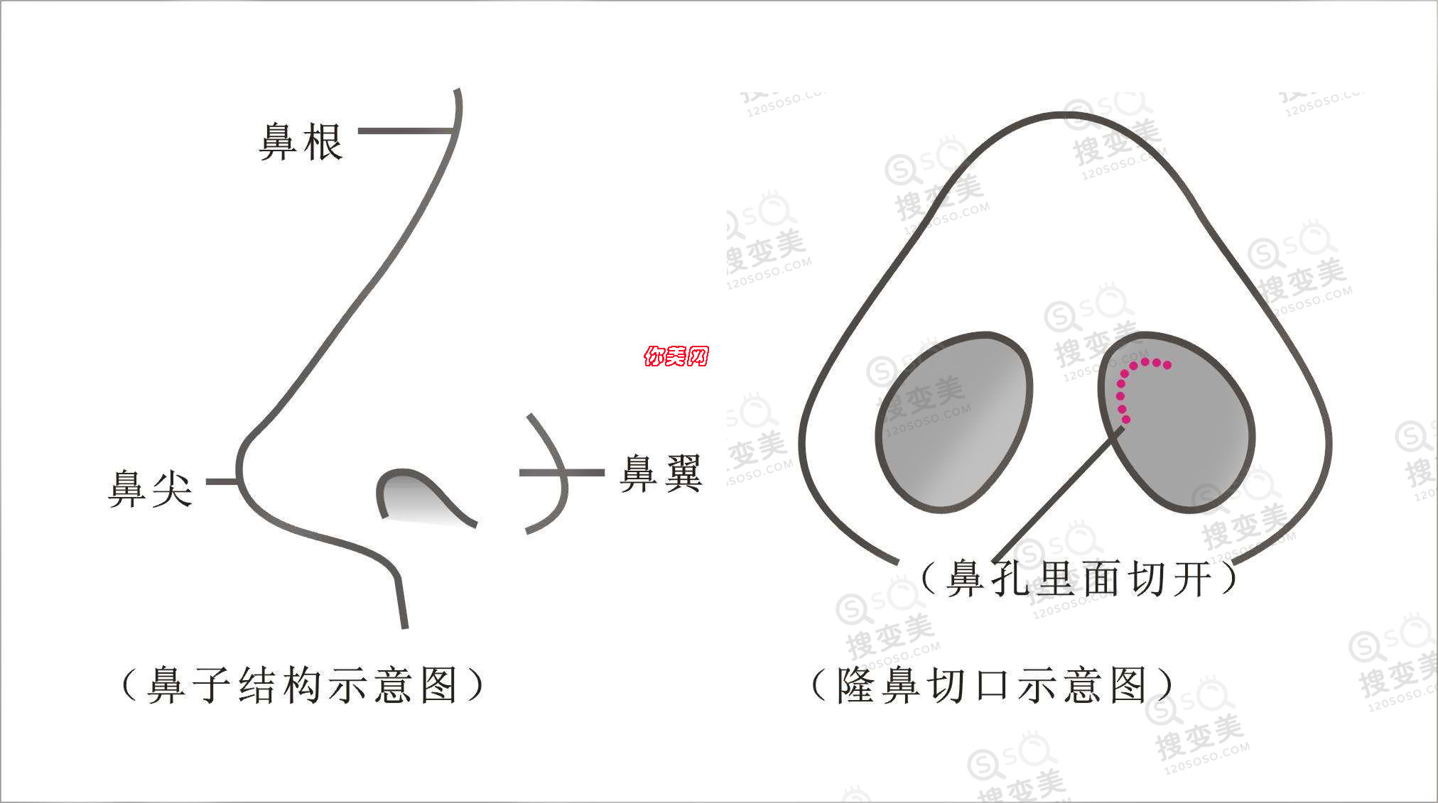 假体隆鼻容易失败吗？会出现透光、穿透鼻子的情况吗