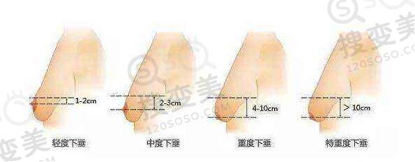 造成胸部下垂的原因是什么？该如何改善呢？