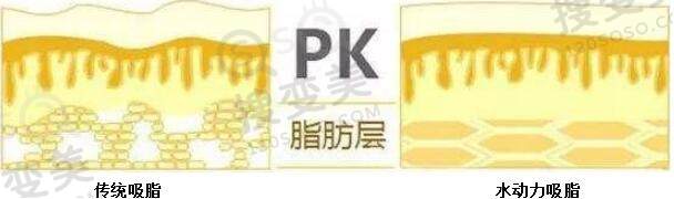水动力吸脂前需要了解的几件事！