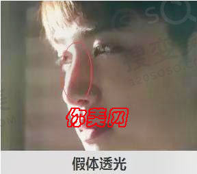 假体隆鼻出现透光怎么办