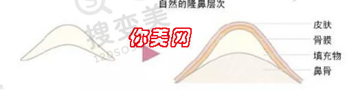 假体隆鼻出现透光怎么办