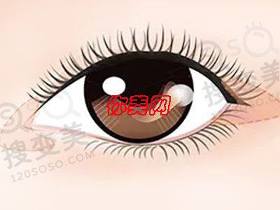 开眼角会有什么后遗症