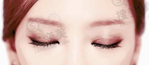 双眼皮手术后注意这些避免疤痕赖上你
