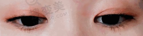 双眼皮手术后注意这些避免疤痕赖上你