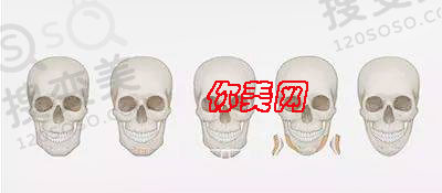 磨骨常见的几个问题