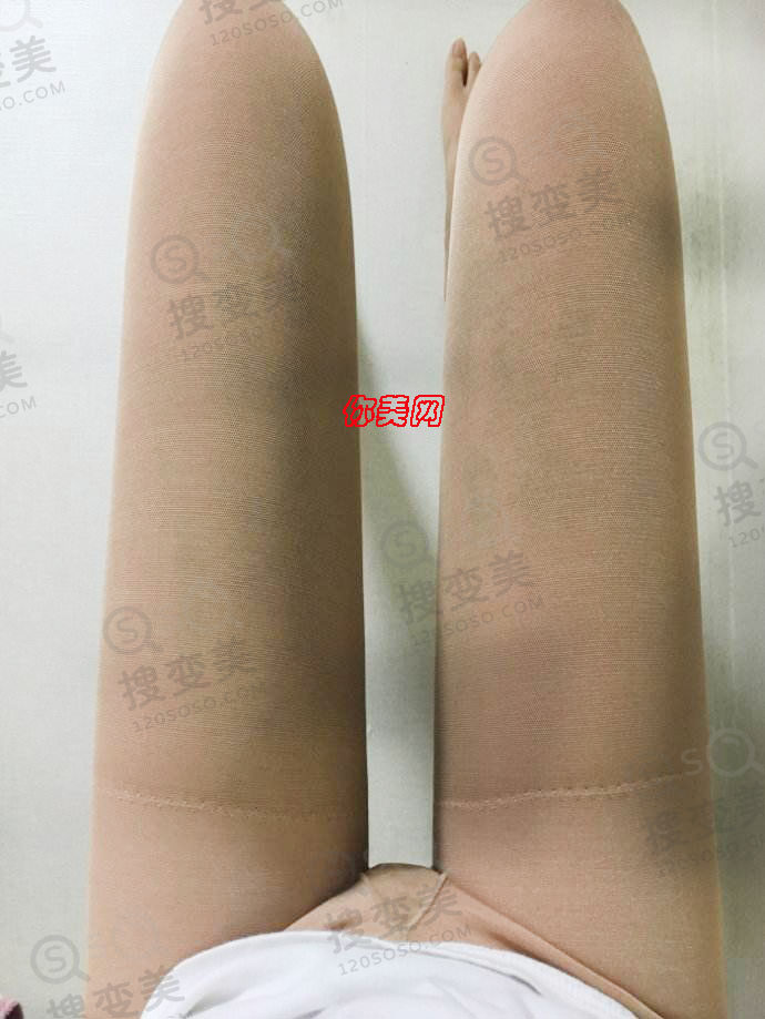 什么是大腿环吸，它手术是怎么样的