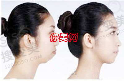 正颌手术多久可以消肿，应该注意些什么