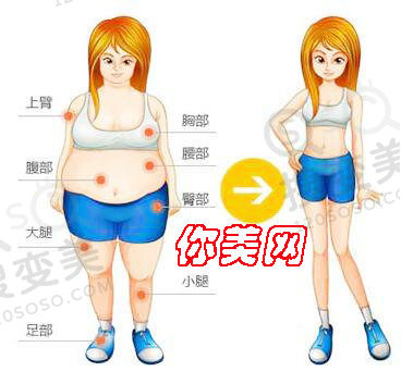吸脂减肥会有后遗症吗