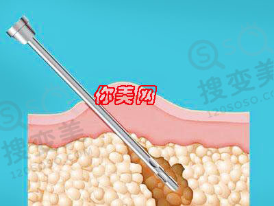 吸脂减肥会有后遗症吗