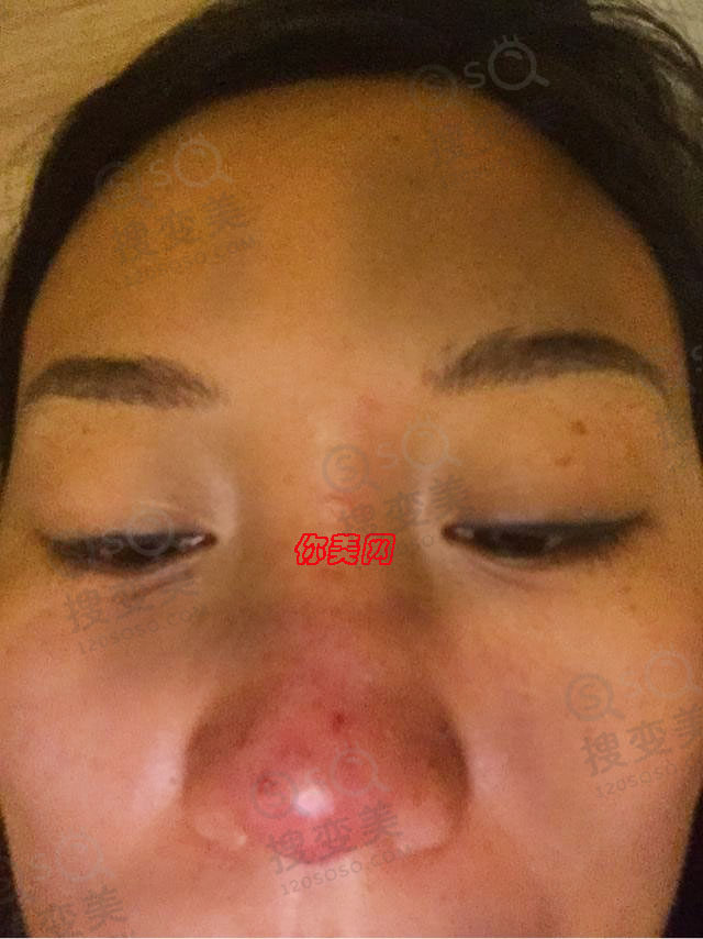 怎么避免假体隆鼻术后感染