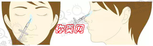 隆鼻材料该如何选择，各有什么优缺点