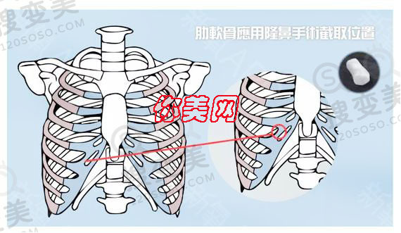 隆鼻材料该如何选择，各有什么优缺点