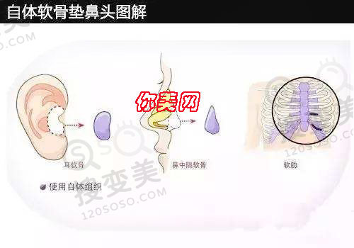 自体软骨隆鼻采用异体骨有什么副作用