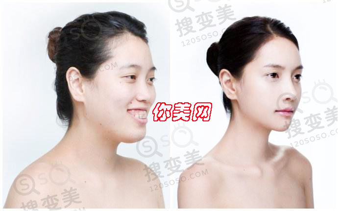 突嘴矫正手术以及自测法