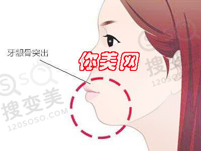 突嘴矫正手术以及自测法