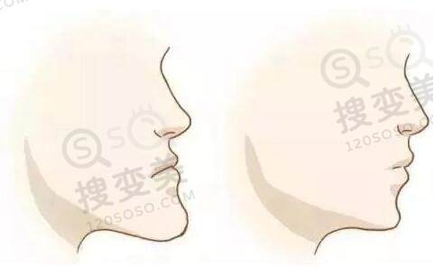 假性地包天该如何分辨？