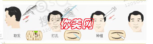 植眉和植发有什么关系