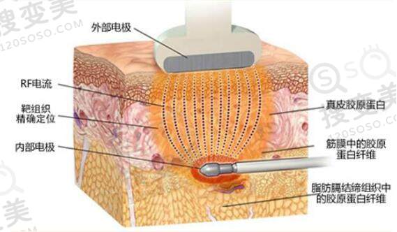 关于激光溶脂