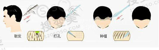 植发有什么后遗症，会对头发神经造成伤害吗