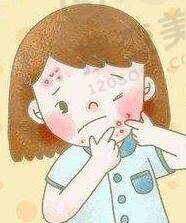 祛痘印的方式有哪些？
