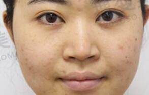 祛痘印的方式有哪些？