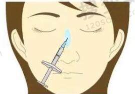 玻尿酸隆鼻会使鼻梁变宽吗？