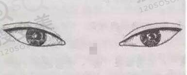 哪种情况需要做开眼角？