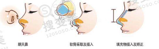 朝天鼻矫正需要注意什么？