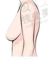 乳房下垂的危害及自测方法