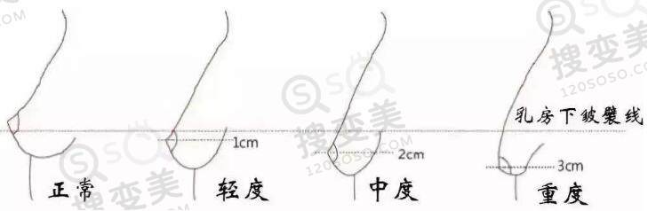 乳房下垂的危害及自测方法