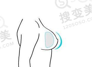 哪种丰胸方式比较安全？