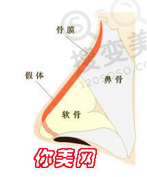 假体隆鼻注意这6点离成功便不远了