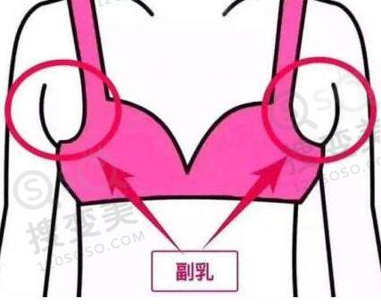 吸脂去副乳的注意事项