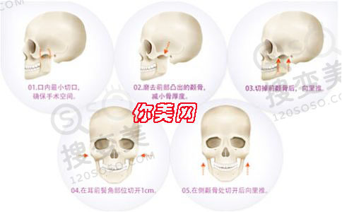 颧骨内推能解决大脸的问题吗
