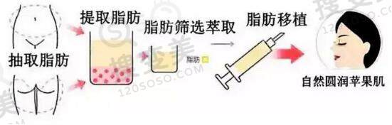 自体脂肪丰苹果肌的好处