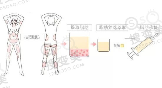 做完自体脂肪面部填充多久才能消肿