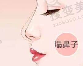 捏鼻子鼻梁会变高吗？