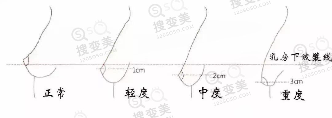 乳房下垂矫正手术安全吗？有什么副作用