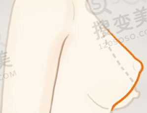 乳房下垂矫正手术安全吗？有什么副作用