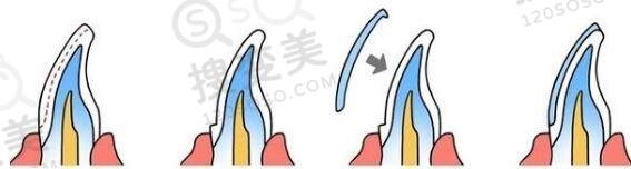 瓷贴面是什么？价格怎么算？