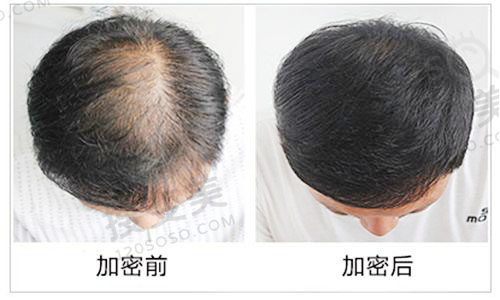 头发加密价格多少？
