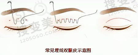 埋线双眼皮多久可以碰水