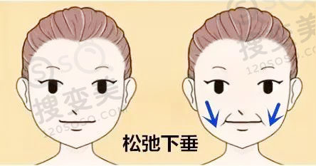 面部脂肪多的人适合做埋线提升吗